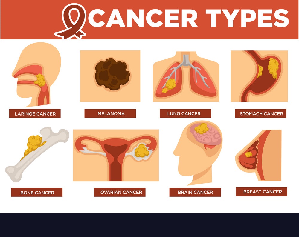 Cancer Types Chandigarh Cancer Diagnostic Center